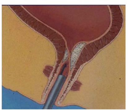 Injection of bulking agent in urethra using an endoscope