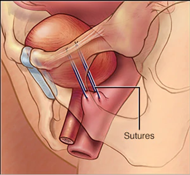 Bladder neck suspension